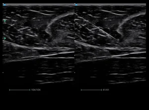 Needle-Enhancement
