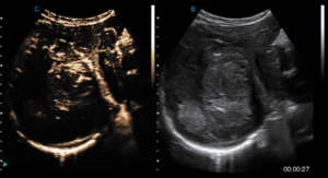 Ultrasound-Contrast-Imaging
